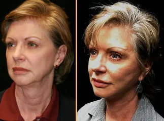 A middle-aged woman before and after a facelift