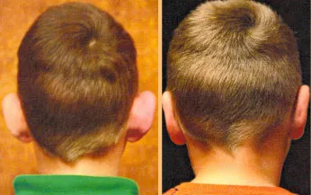 otoplasty before and after on a young boy