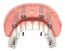 upper denture
