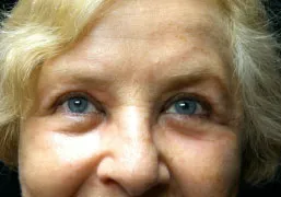 An older woman after facial cosmetic surgery