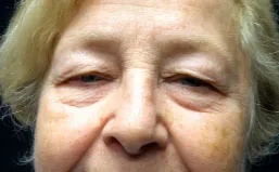An older woman before facial cosmetic surgery
