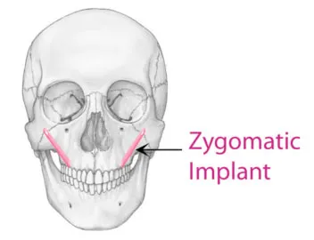 zygomatic implant graphic