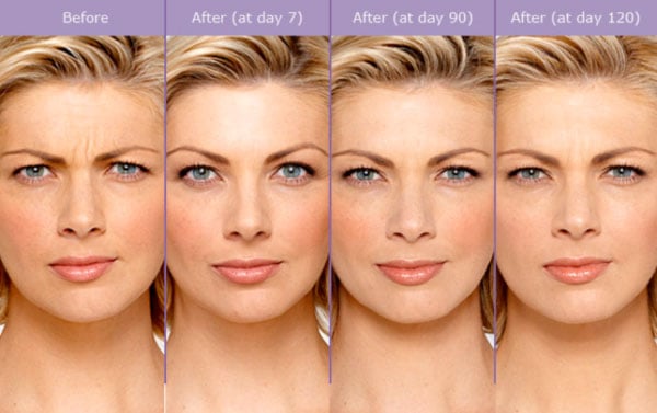 Botox before and after poster