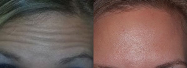 forehead wrinkles, before and after botox