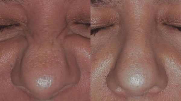 nose, before and after