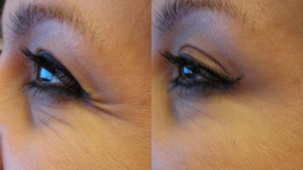 crow's feet wrinkles, before and after