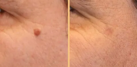 Facial mole, before and after removal