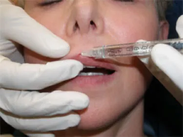 woman getting facial fillers injected