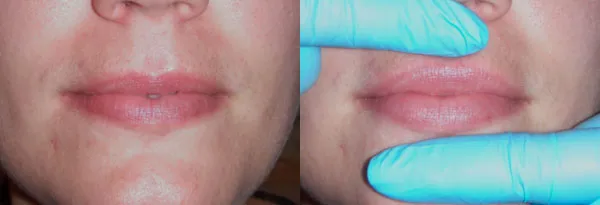 lips, before and after facial fillers