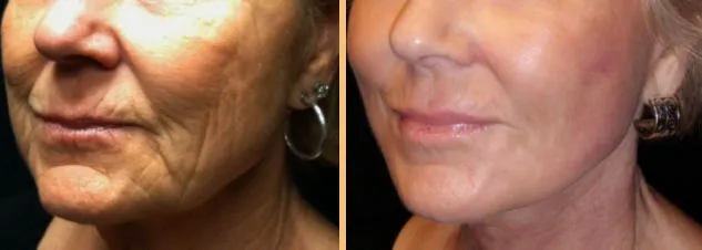 Before and after on a woman face wrinkles