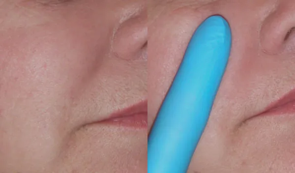 smile lines, before and after facial fillers