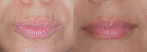 lips, before and after