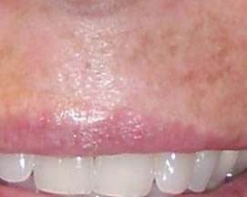 A removed mole on an upper lip