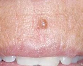 A mole on an upper lip